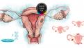 Endometriosis, una enfermedad que afecta a una de cada 10 mujeres en edad reproductiva