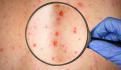 Detectan dos casos de viruela símica en el Edomex