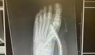 Radiografía del pie de la mujer con el tacón enterrado
