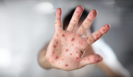 Actualmente existen vacunas para prevenir los contagios de sarampión