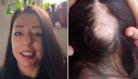 Una británica de 45 años afirmó que la caída de cabello le hizo darse cuenta que tuvo Covid-19.