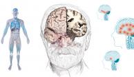 Descubren que el Alzheimer se desarrolla de diferente manera de lo que se pensaba