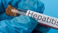 Reportan caso sospechoso de hepatitis aguda infantil en Nayarit