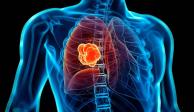 El cáncer de pulmón es el quinto en el tipo de cáncer que aqueja a los mexicanos