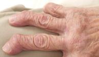 Día Mundial de la Artritis y las Enfermedades Reumáticas