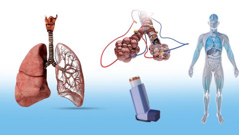 Nocaut técnico contra el asma; nuevo tratamiento promete erradicarla