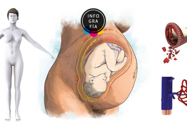 Nuevo análisis de ARN predice la preeclampsia durante el embarazo