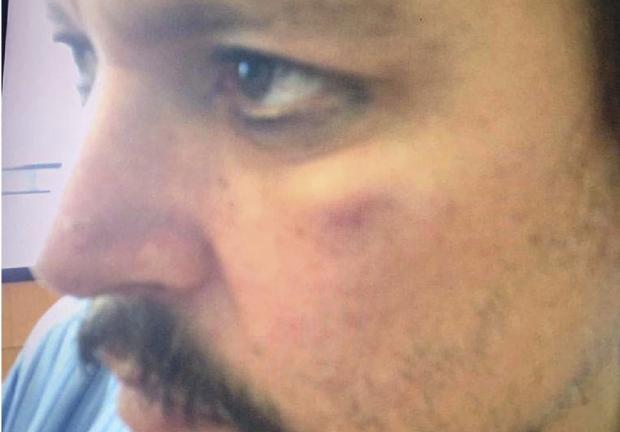 Johnny Depp con lesiones presuntamente sufridas por Amber Heard durante un incidente en Los Ángeles en marzo de 2015.