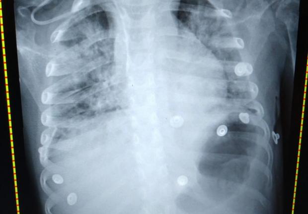 Así se veían los pulmones de la niña, que estuvo grave durante días, razón por la que el médico rechaza el regreso a clases presenciales