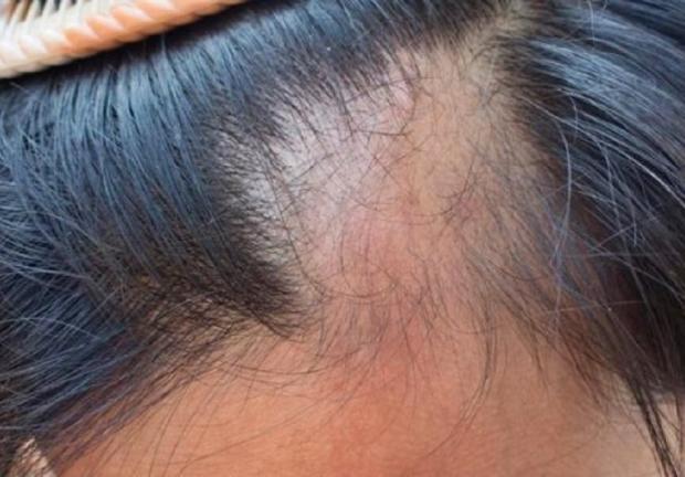Caída del cabello en cantidades significativas o alopecia, puede ser una secuela de COVID-19