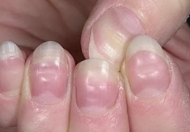 El caso de las 'lineas de Beau' en las uñas podría darse en pacientes con COVID-19 pero no es un síntoma exclusivo