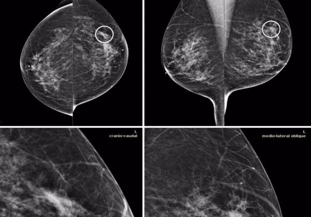 El cáncer de mama, cuando se detecta tardíamente, cobra decenas de vidas.