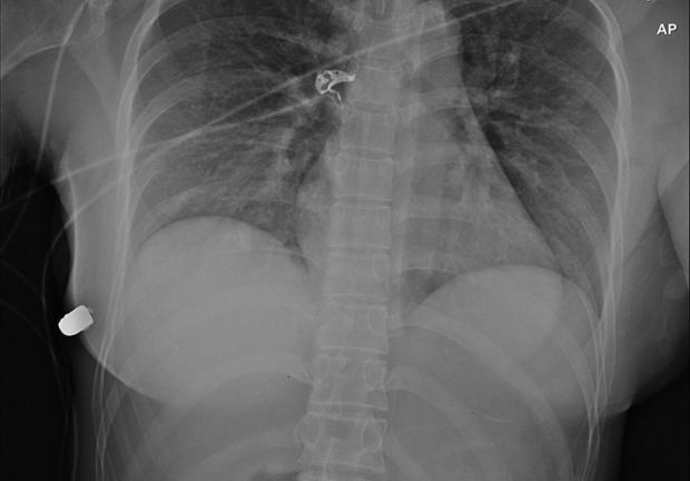 Radiografía de los implantes con la bala.