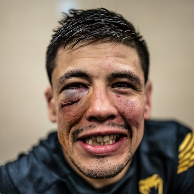 Así quedó el rostro de Brandon Moreno, tras su pelea en UFC 277 ante Kai Kara-France