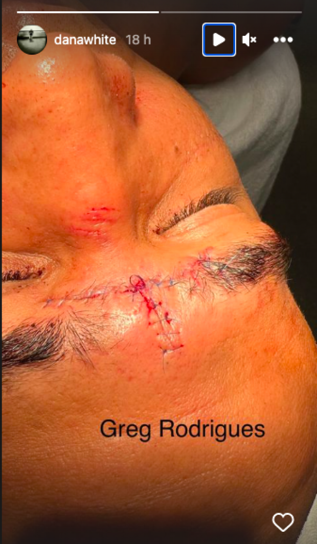 UFC: Así quedó la herida de Gregory "Robocop" Santos