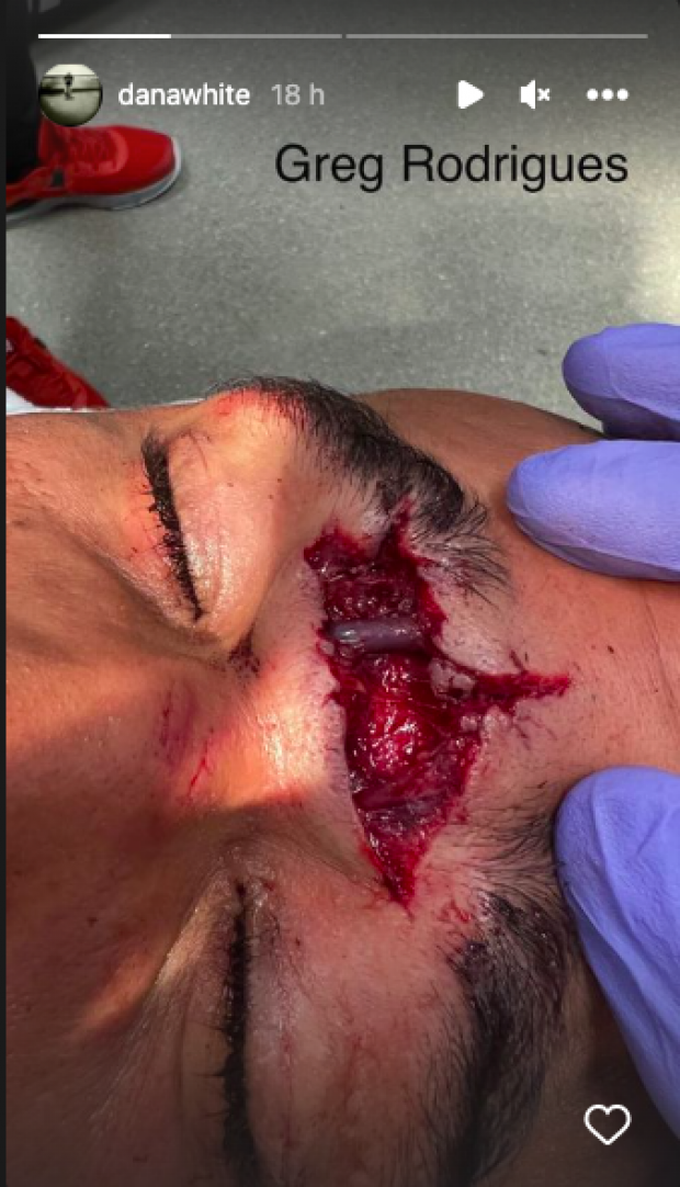 UFC: Así estaba la herida de Gregory "Robocop" Santos