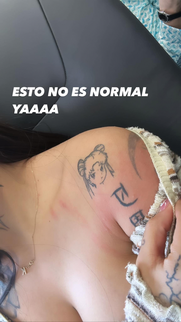 Karely Ruiz sufre alergia tras ataque a huevazos