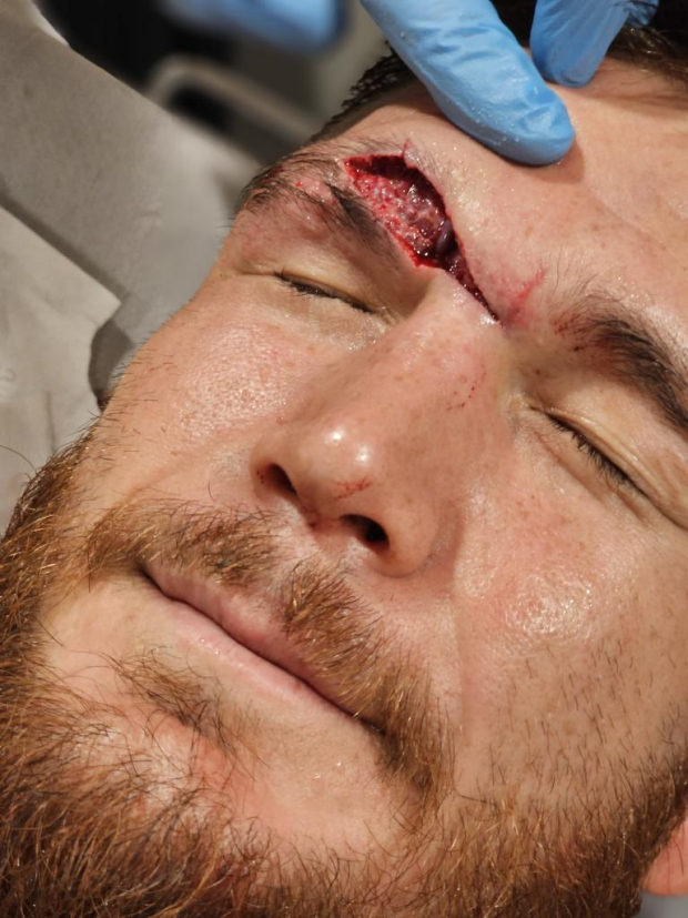 Johnny Eblen sufrió un escalofriante corte arriba de la ceja en Bellator