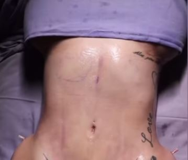 Así quedó el abdomen de Karely Ruiz tras la cirugía de liposucción