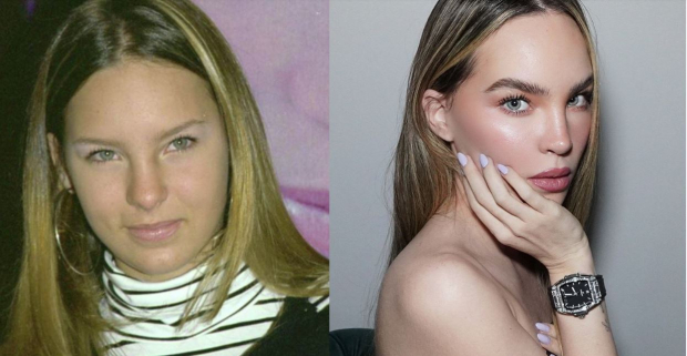 Belinda antes y después de las cirugías