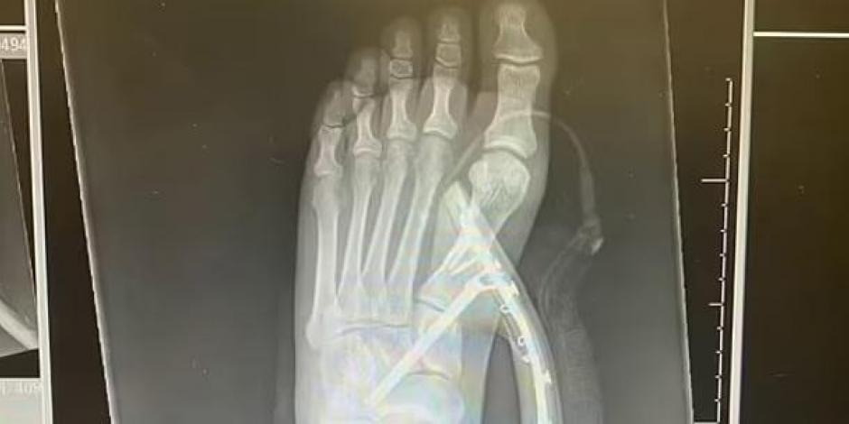 Radiografía del pie de la mujer con el tacón enterrado