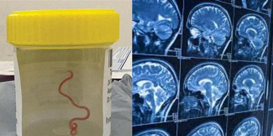 Médicos retiran una lombriz viva del cerebro de una mujer de 64 años; este parásito solo vive en los estómagos de los pitones.