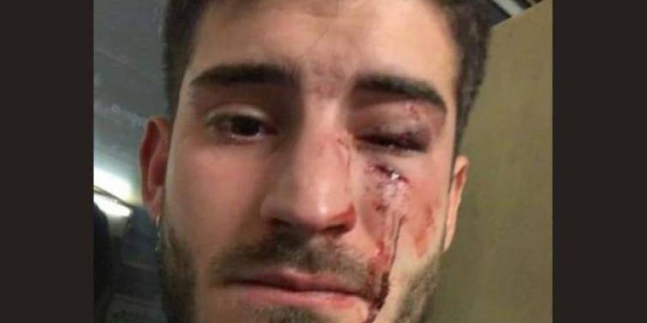 FOTOS: Joven sufre brutal agresión por homofobia en metro de Barcelona