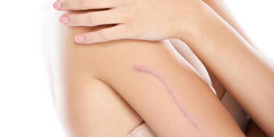 Técnicas para atenuar las cicatrices de manera no invasiva