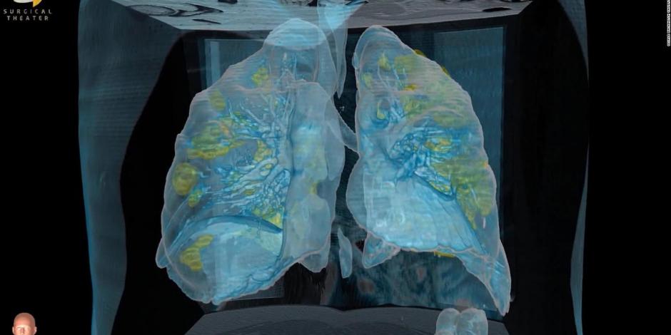 Tomografías del hospital de la Universidad George Washington, en la cual se muestran los daños que provoca el COVID-19 en los pulmones.