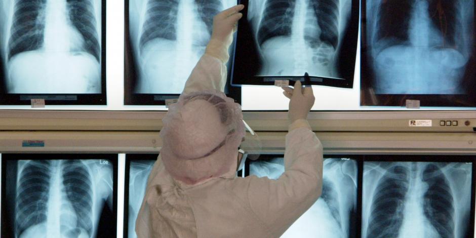 Publican radiografías de pulmones con COVID-19 con vacuna y sin ella