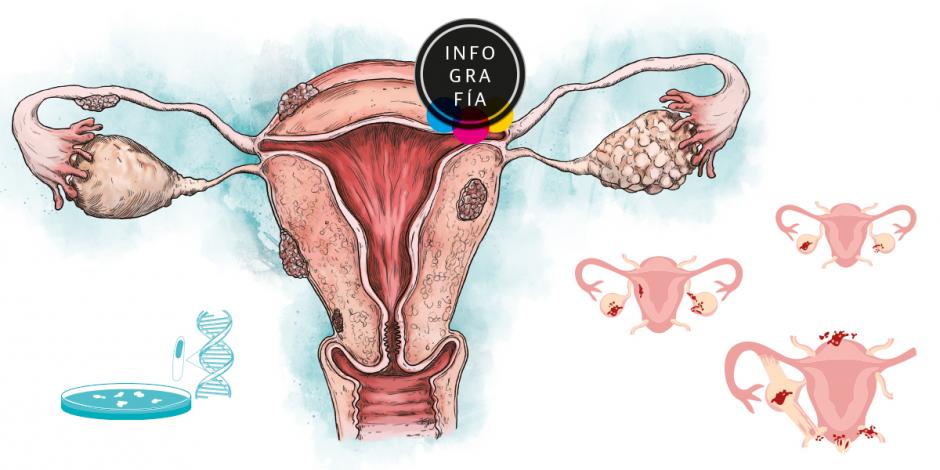Descubren conexión genética entre la endometriosis y el cáncer de ovario