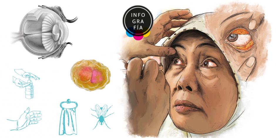 Tracoma, la enfermedad infecciosa que causa ceguera, aún es un problema en África y Asia