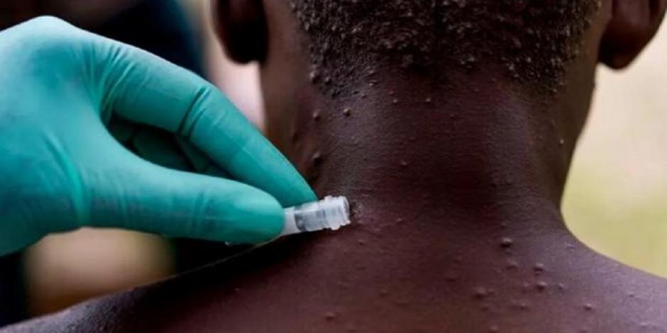 La OMS estima que la enfermedad es mortal para una de cada 10 personas, pero las vacunas contra la viruela protegen y también se están desarrollando algunos medicamentos.