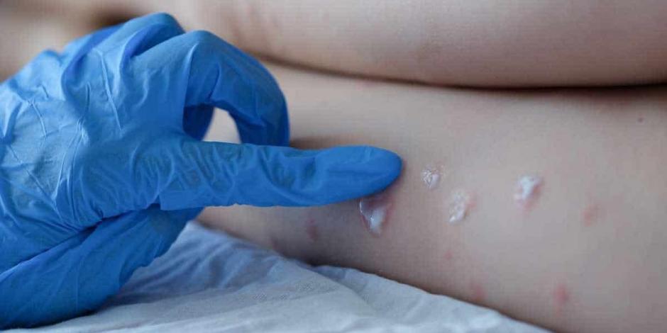Chihuahua confirma sus dos primeros casos de viruela símica; se trata de dos hombres contagiados. 