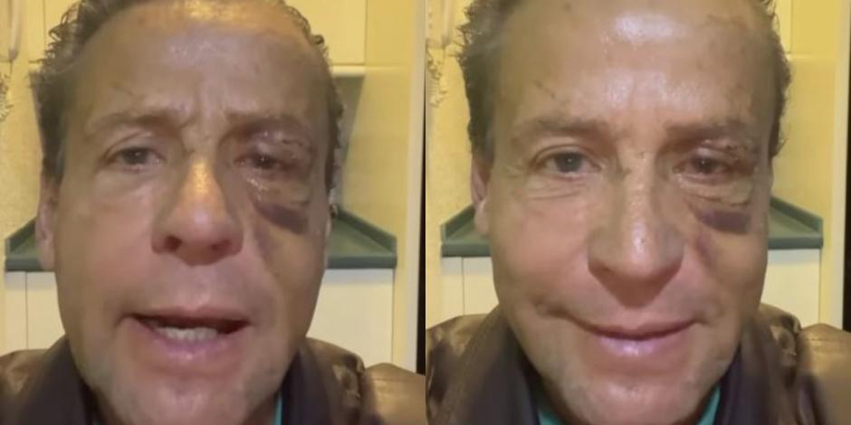 Alfredo Adame es operado de la cara tras golpiza