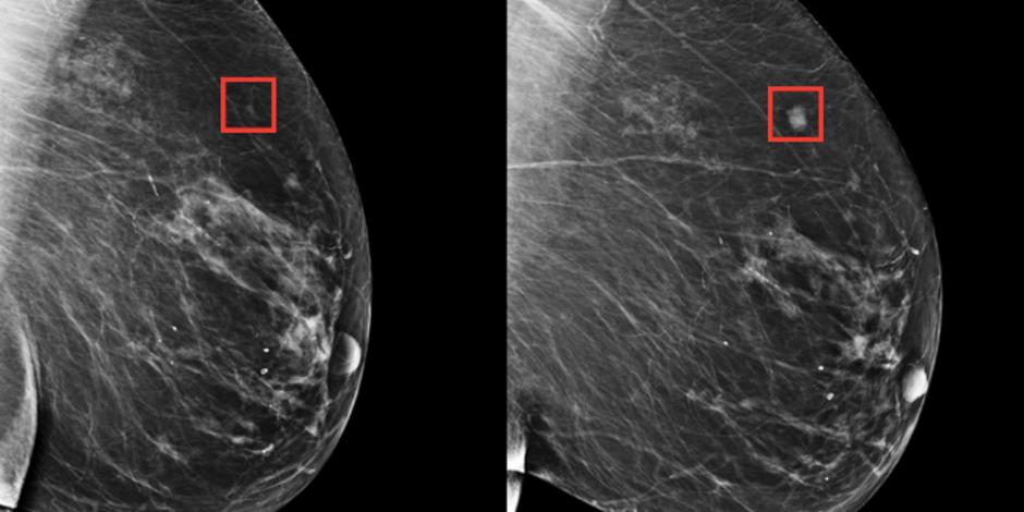 El cáncer de mama podría ser detectado con cinco años de anticipación.