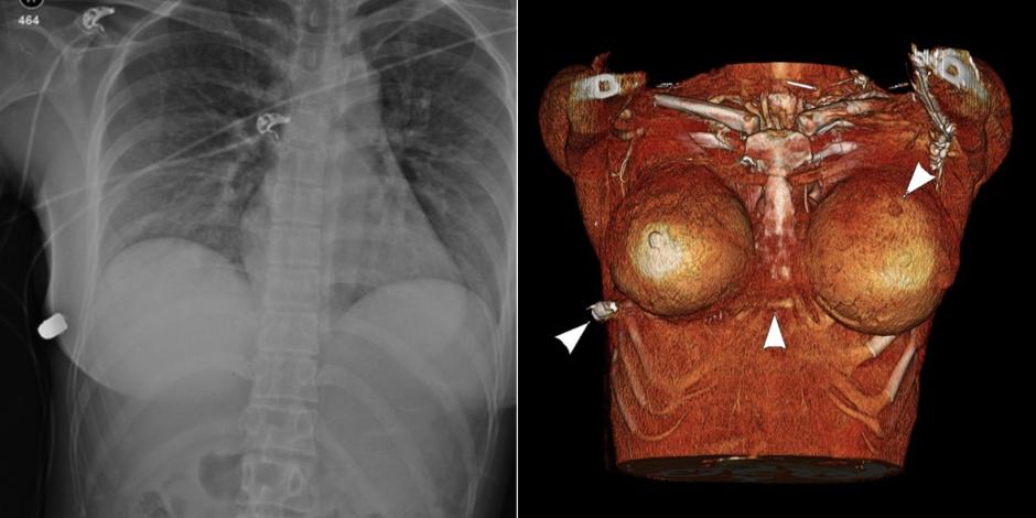 Mujer recibe un disparo en el pecho e implantes de senos la salvan de morir de un impacto en el corazón.