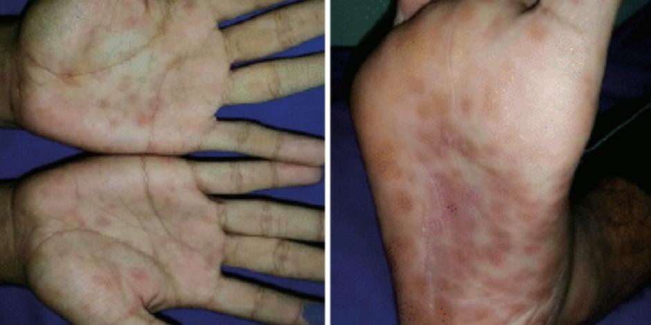 El virus coxsackie afecta manos, pies y boca. 