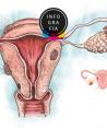 Descubren conexión genética entre la endometriosis y el cáncer de ovario