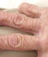 Día Mundial de la Artritis y las Enfermedades Reumáticas