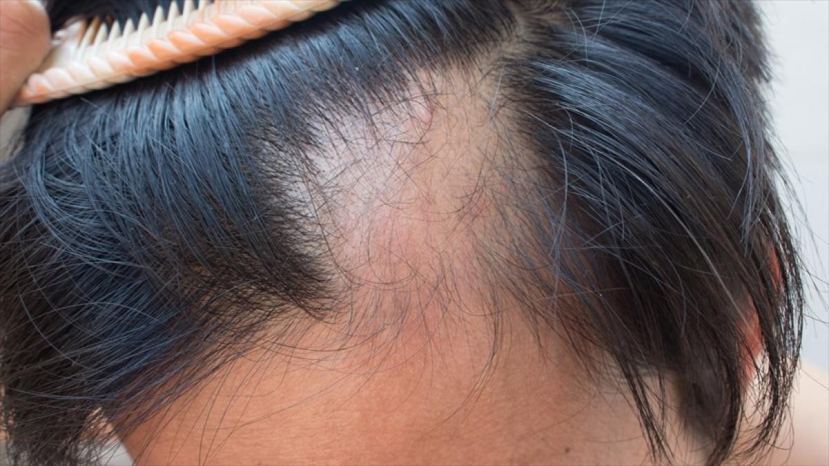 Pérdida de cabello asociada al estrés, y ansiedad