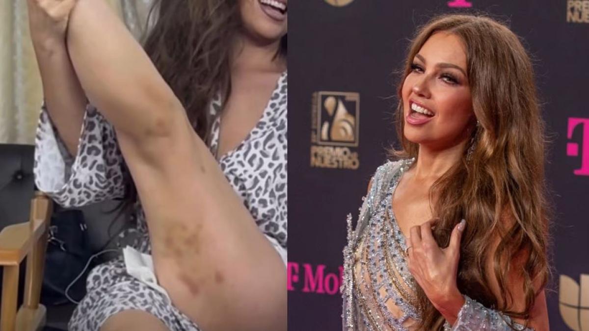 Thalía preocupa al mostrar los moretones en sus piernas ¿Le pegaron? (VIDEO)