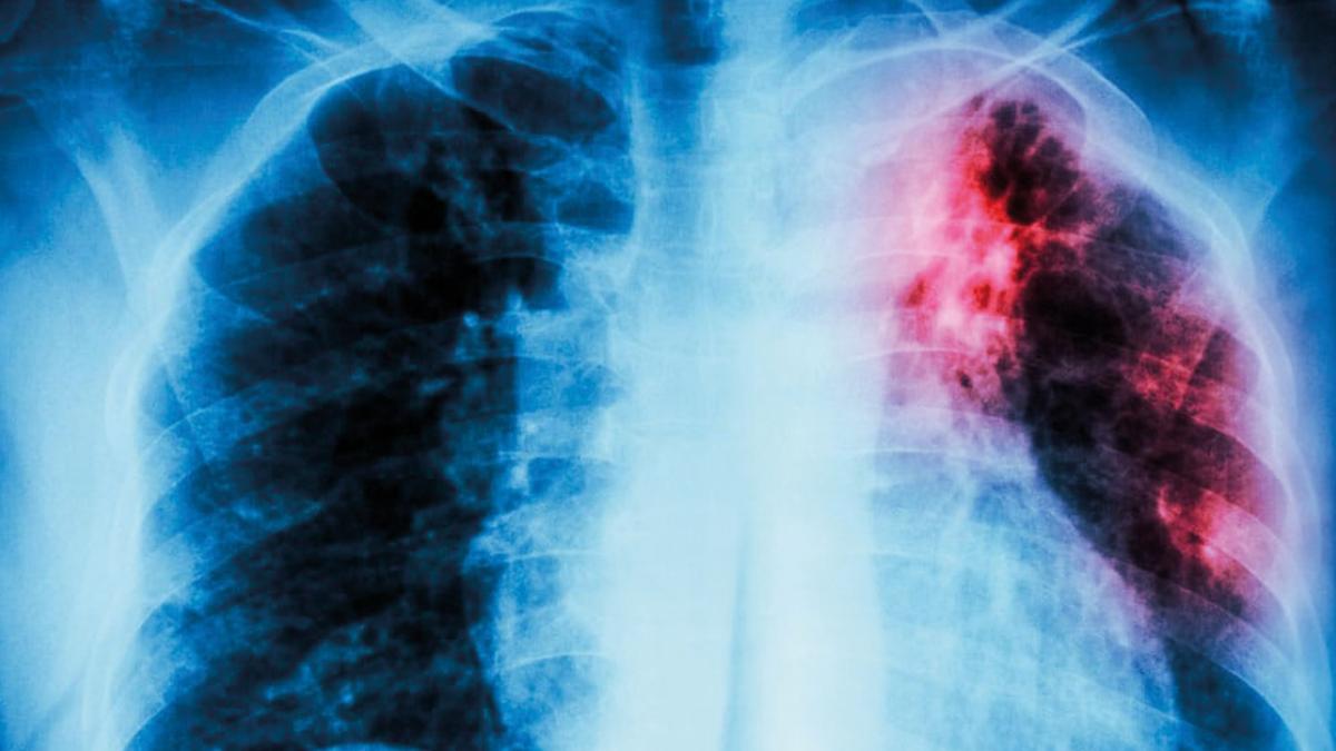 Tuberculosis, al alza en 13 estados del país