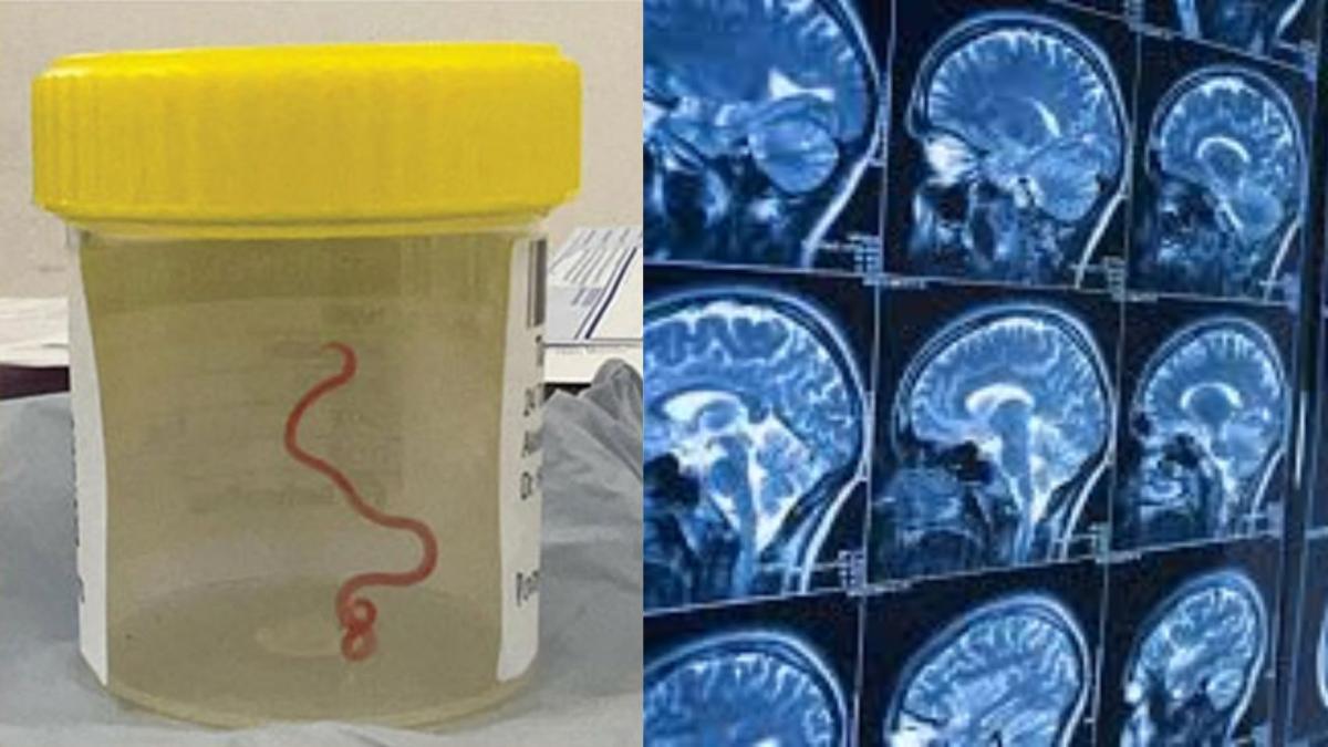 Médicos retiran una lombriz viva del cerebro de una mujer de 64 años