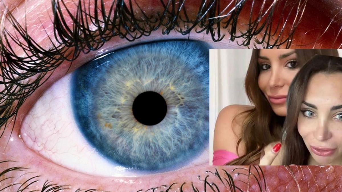 ¿Se puede cambiar el color de los ojos? Influencer se hace procedimiento médico y esto pasó