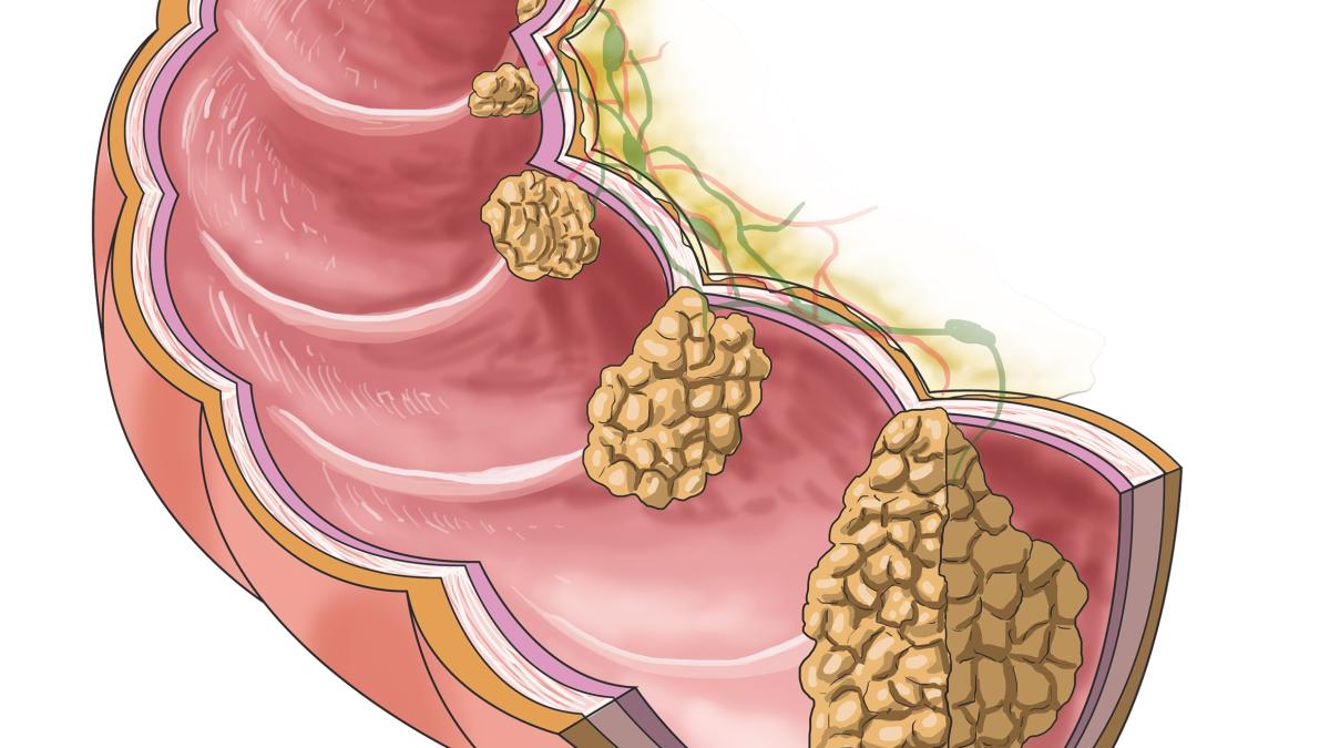 Repunta el cáncer colorrectal en personas cada vez más jóvenes