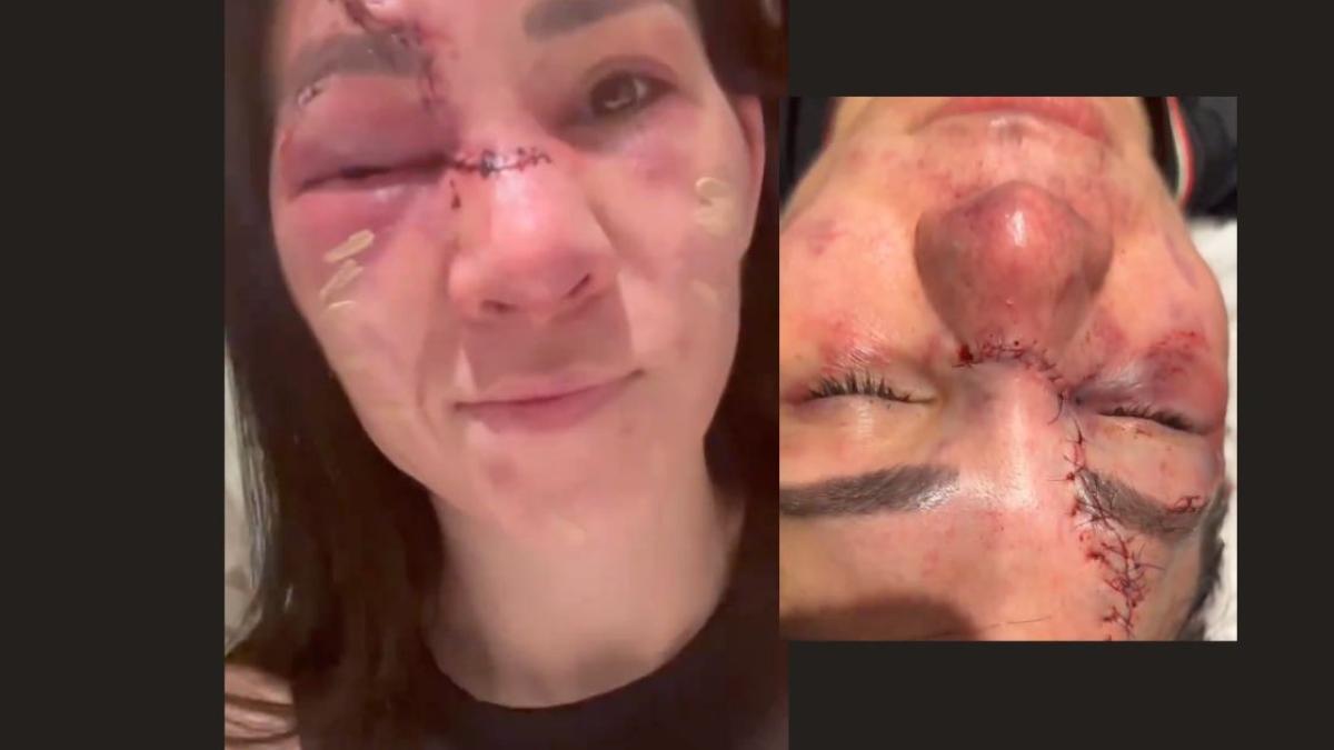 UFC 306: Irene Aldana sube un VIDEO en el que muestra cómo le quedó destruido su rostro